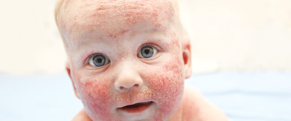 Cure Eczema